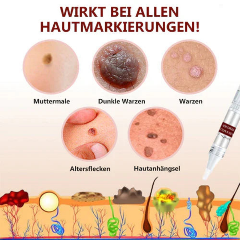 1+1 Gratis! - SkinClear™ Tags & Maulwurfsentferner