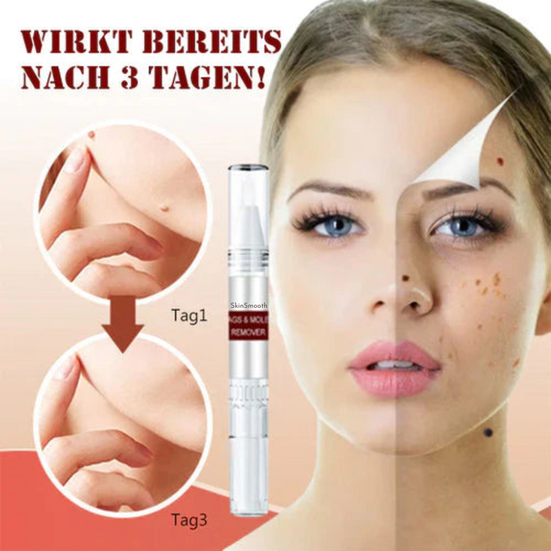 1+1 Gratis! - SkinSmooth™ Tags & Maulwurfsentferner