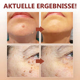 1+1 Gratis! - SkinClear™ Tags & Maulwurfsentferner