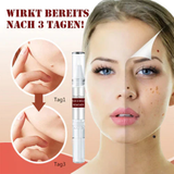 1+1 Gratis! - SkinClear™-tags en molverwijderaar 