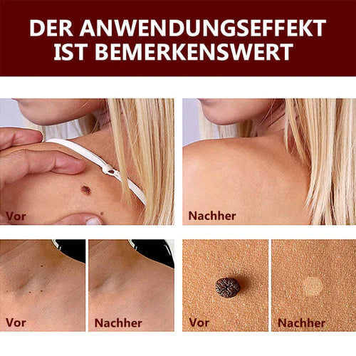 1+1 Gratis! - SkinSmooth™ Tags & Maulwurfsentferner