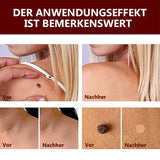 1+1 Gratis! - SkinClear™ Tags & Maulwurfsentferner