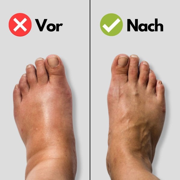 Recovery™ compressie-enkelhoes